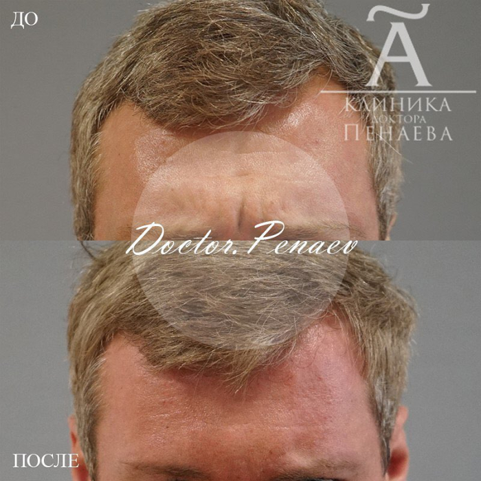 Пациент пластического хирурга Арслана Пенаева до и после Вечного ботокса