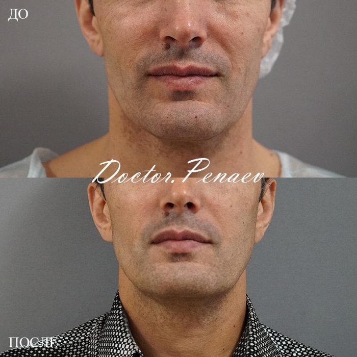 Пациент пластического хирурга Арслана Пенаева до и после омоложения лица