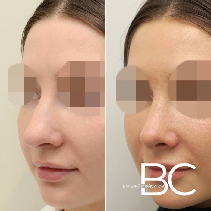 Пациентка пластического хирурга Валерия Стайсупова до и после закрытой ринопластики