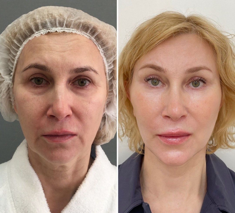 Пациентка доктора Станислава Екимова до и после омоложения лица