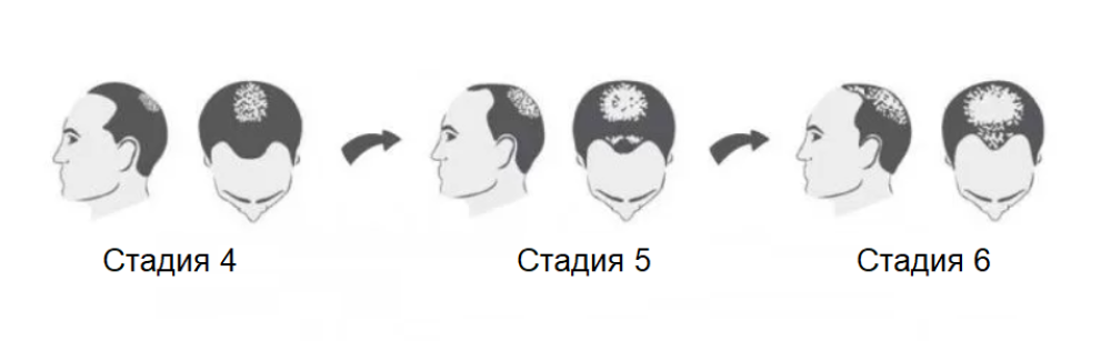 Степени облысения по шкале Норвуда