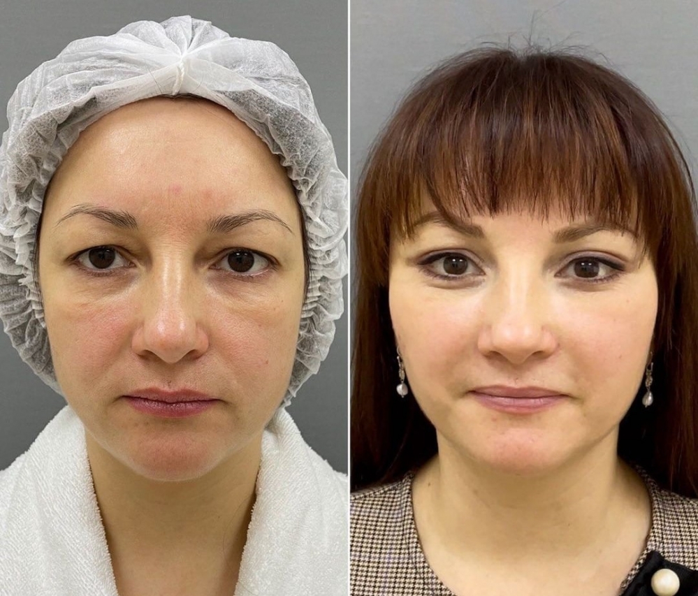 Пациентка пластического хирурга Марины Четвериковой до и после эндоскопического омоложения лица