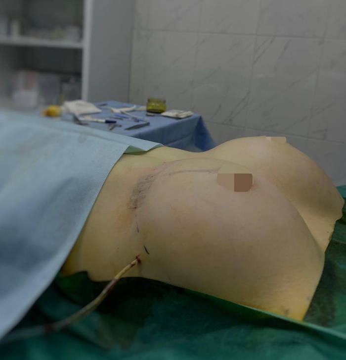 пациентки пластического хирурга Амрама Пайтяна после увеличения груди