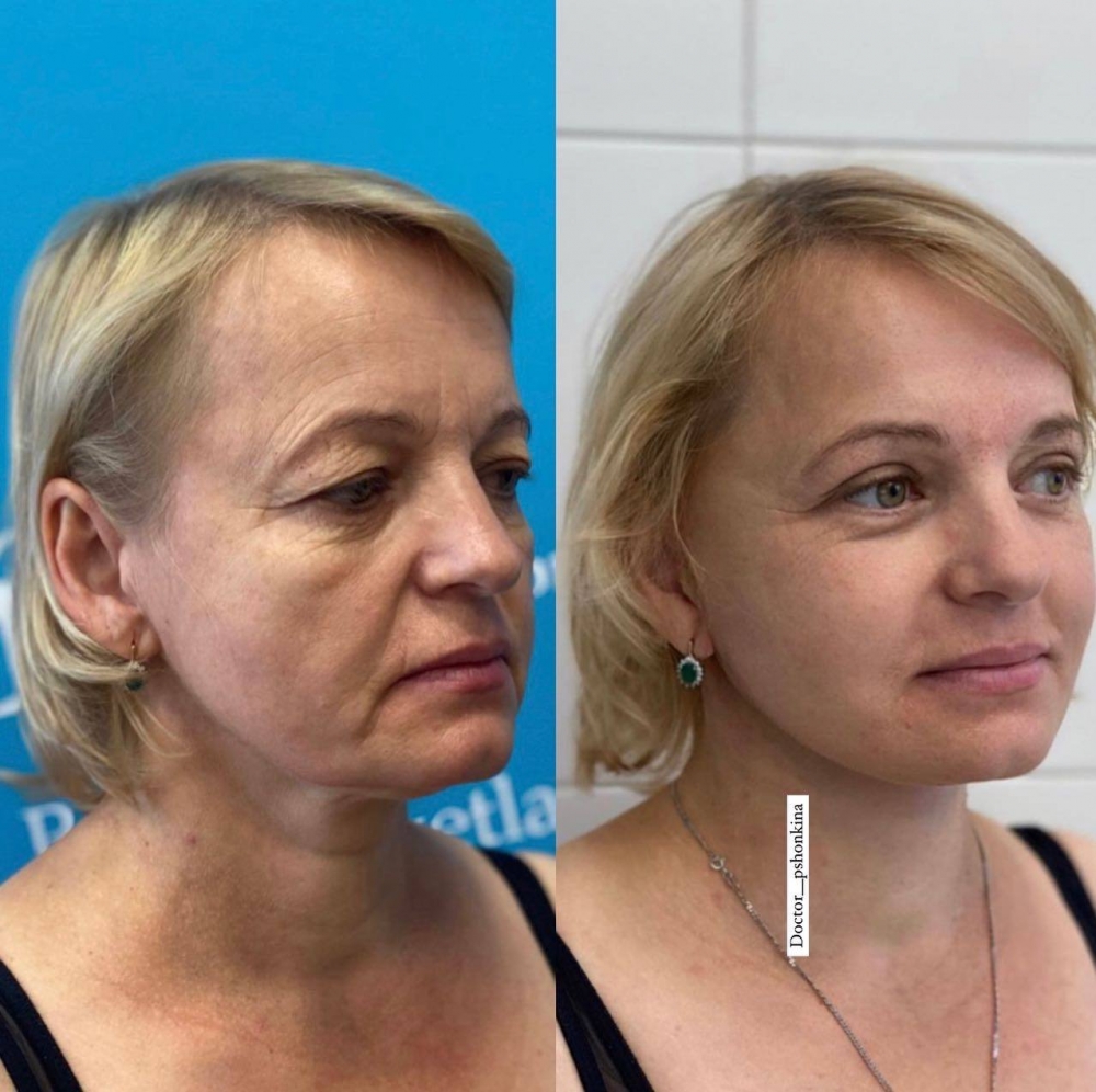 Пациентка доктора Светланы Пшонкиной до и после омолаживающей операции на лице.