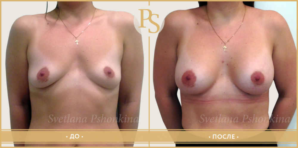 Пациентка пластического хирурга Светланы Пшонкиной до и после увеличения груди