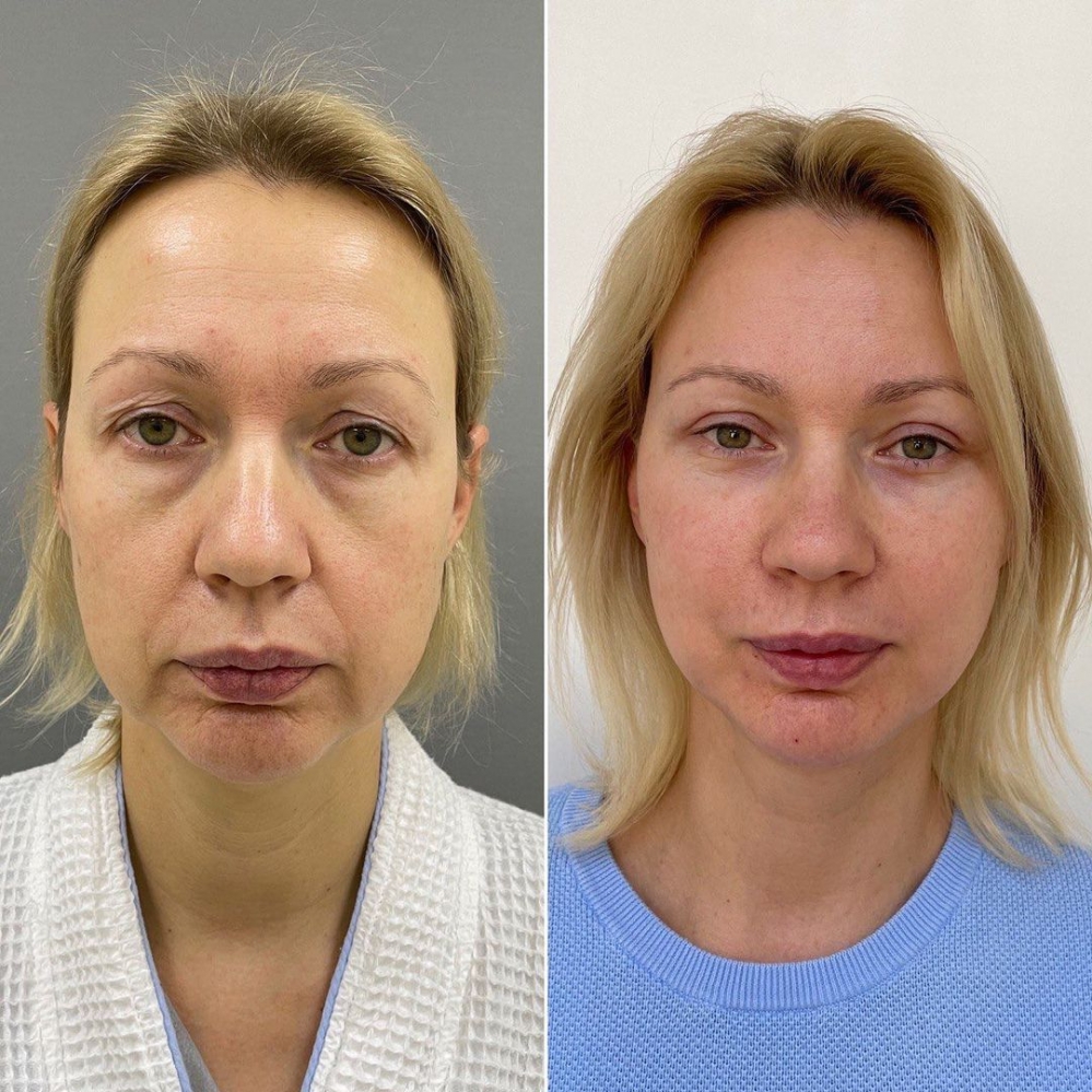 Пациентка пластического хирурга Марины Четвериковой до и после комплексного омоложения лица.