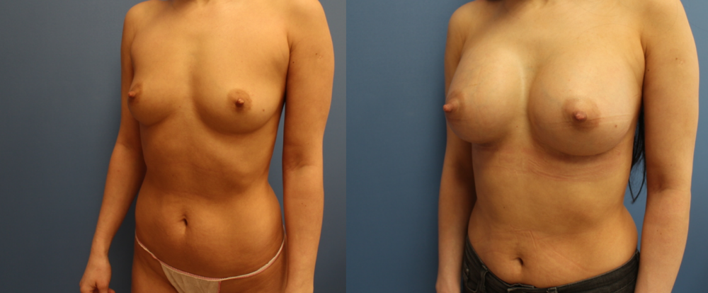 Пациентка пластического хирурга Станислава Екимова до и после увеличивающей маммопластики