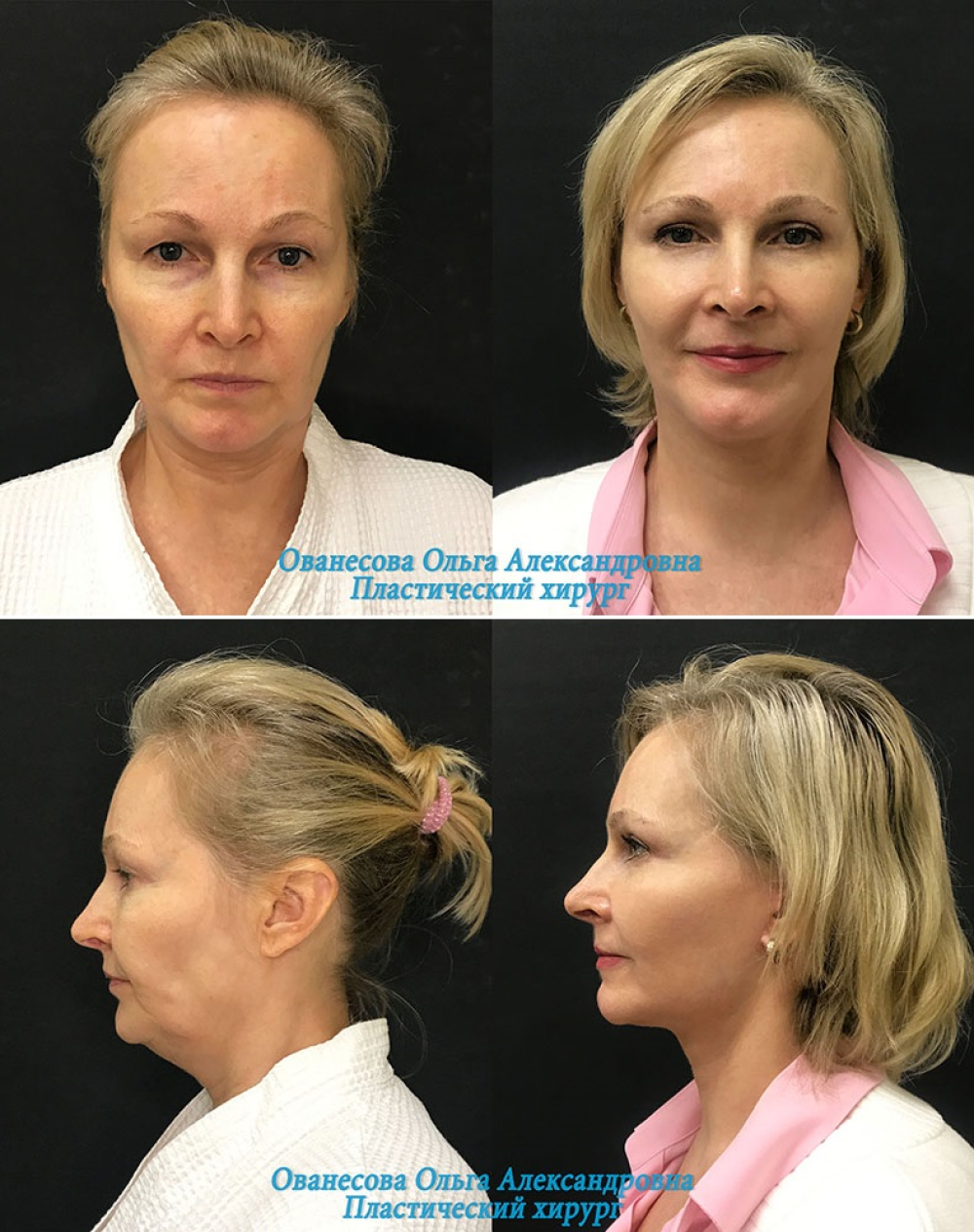 Пациентка пластического хирурга Ольги Ованесовой до и после комплексного омоложения лица, включая удаление брылей
