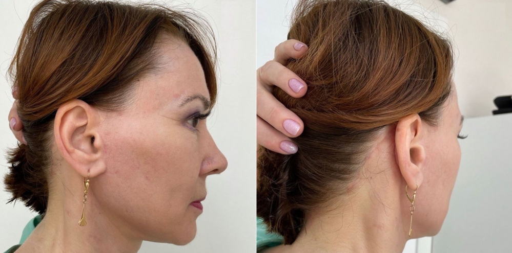 Пациентка пластического хирурга Марины Четвериковой после омолаживающей операции на лице