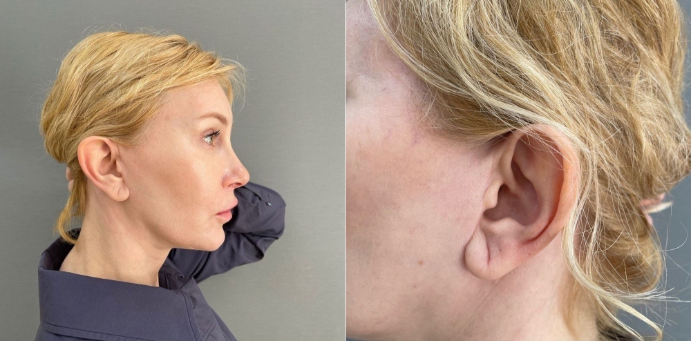 Пациентка пластического хирурга Марины Четвериковой после подтяжки лица. Женщина показывает расположение заживших рубцов