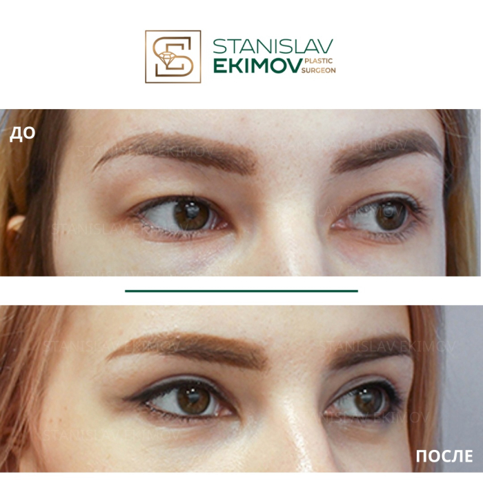 Пациентка пластического хирурга Станислава Екимова до и после трансконъюнктивальной блефаропластики верхних и нижних век