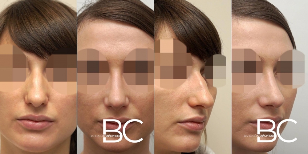 Пациентка пластического хирурга Валерия Стайсупова до и после закрытой септоринопластики.