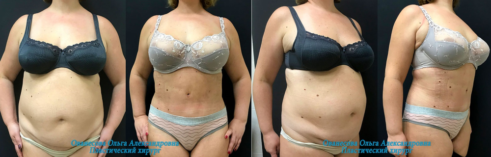 Пациентка пластического хирурга Ольги Ованесовой до и после пластики живота