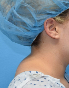 Холка на шее