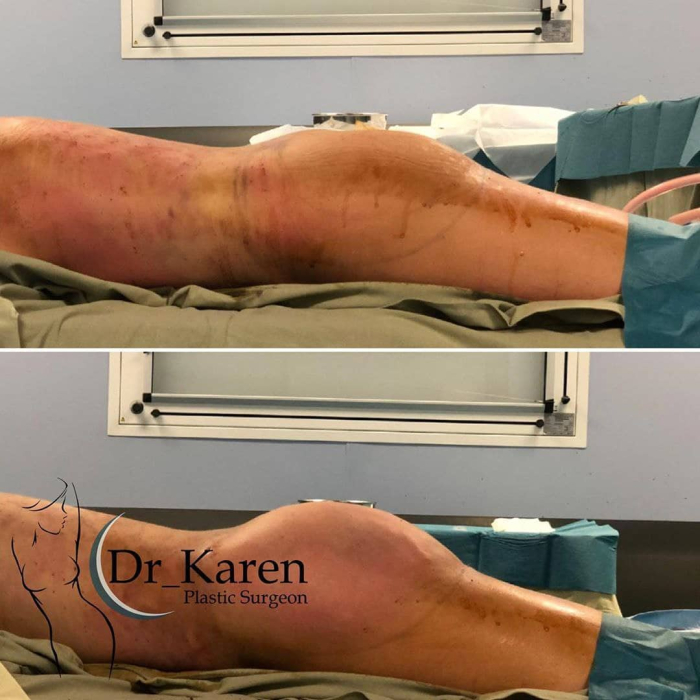 Пациентка пластического хирурга Карена Пайтяна до и после липомоделирования тела с увеличением ягодиц