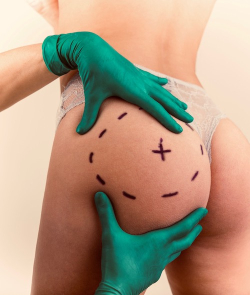 Увеличение ягодиц для женственных изгибов