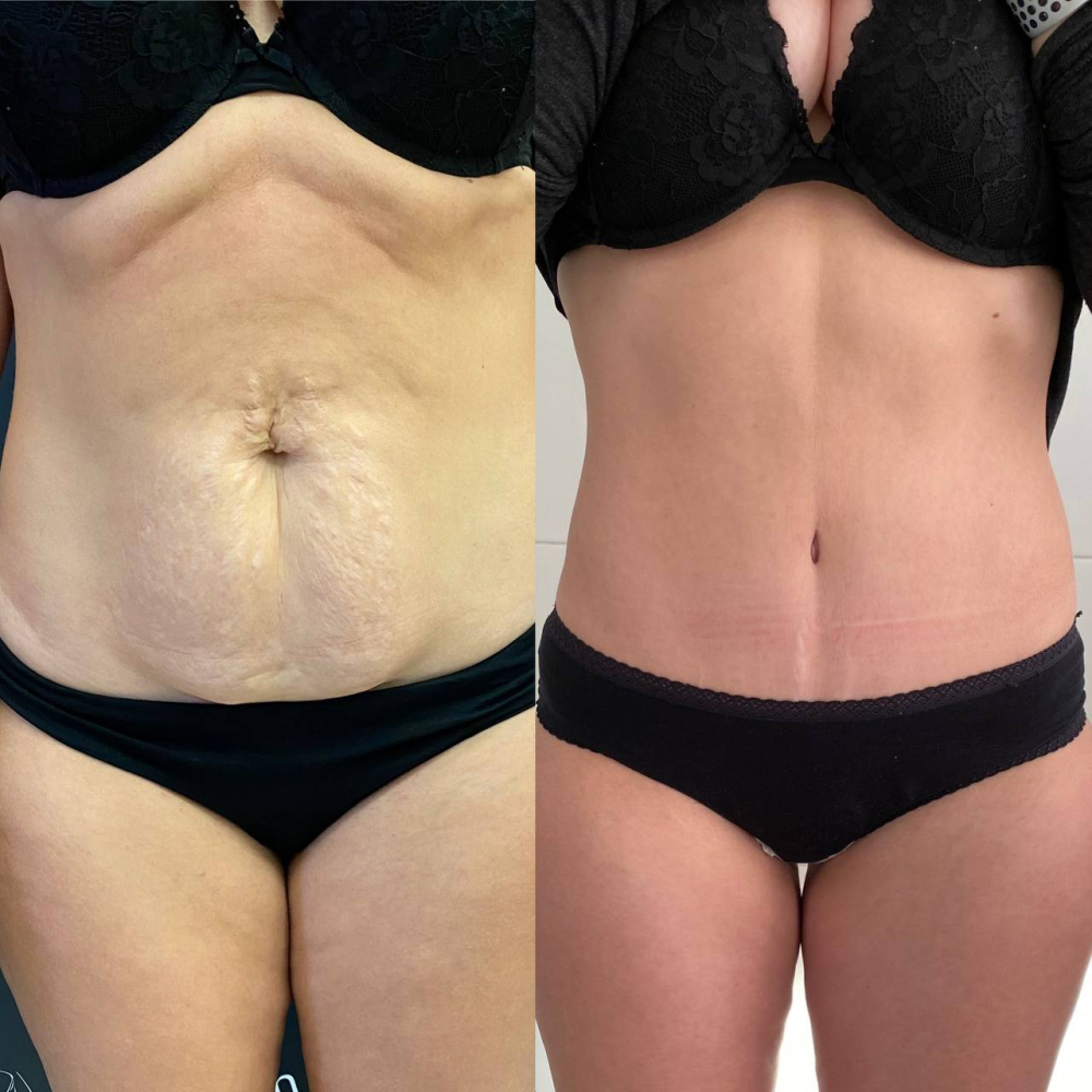 Пациентка Карена Пайтяна до и после абдоминопластики с переносом пупка и с ушиванием диастаза.