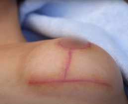 Чего ожидать от шрамов после подтяжки груди