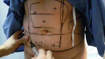 Может ли жир вернуться после операции по липосакции?