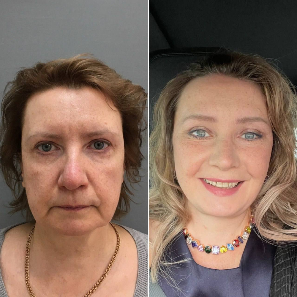 Пациентка пластического хирурга Марины Четвериковой до и спустя 2,5 года после комплексного омоложения лица