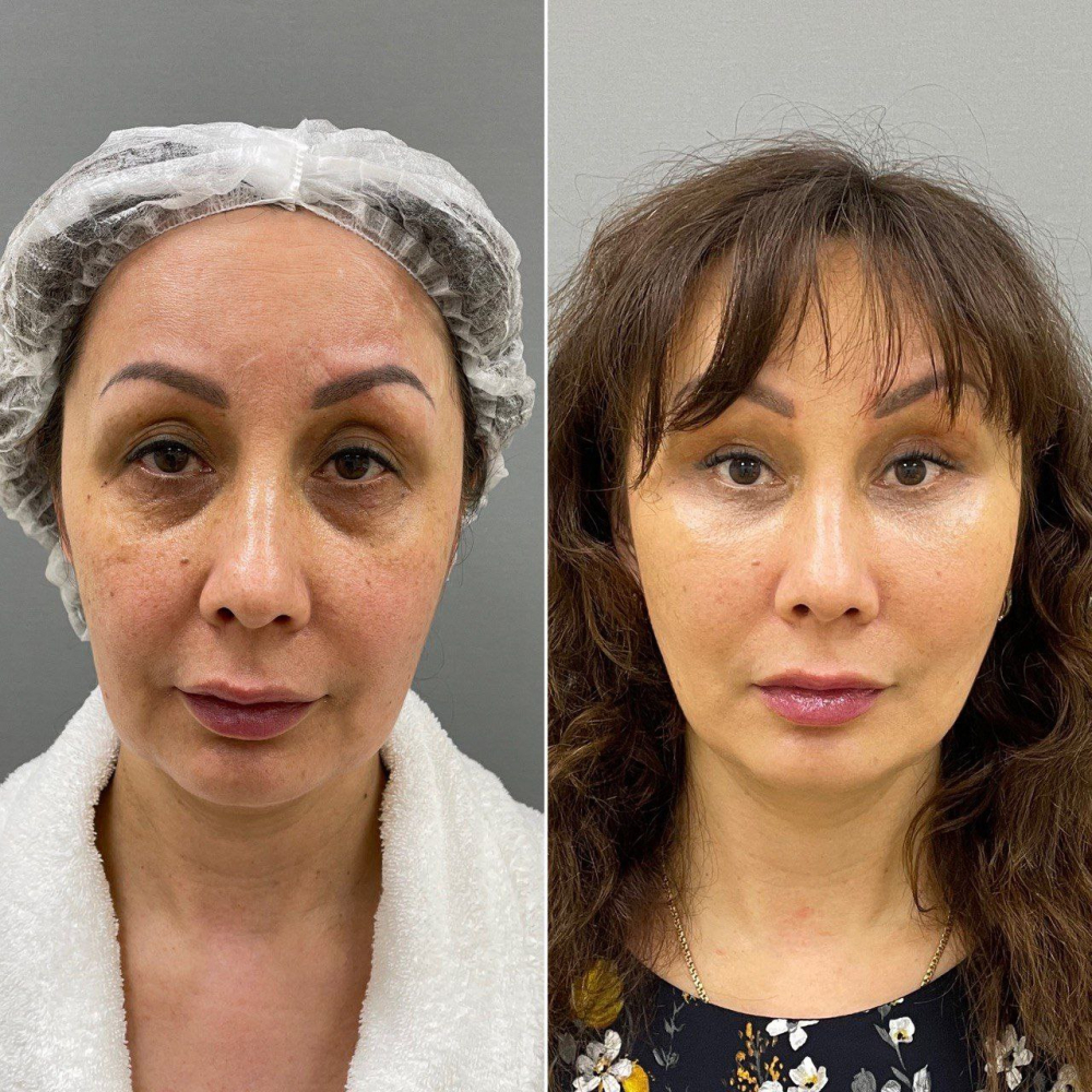 Пациентка пластического хирурга Марины Четвериковой до и после комплексного омоложения лица и верхней блефаропластики