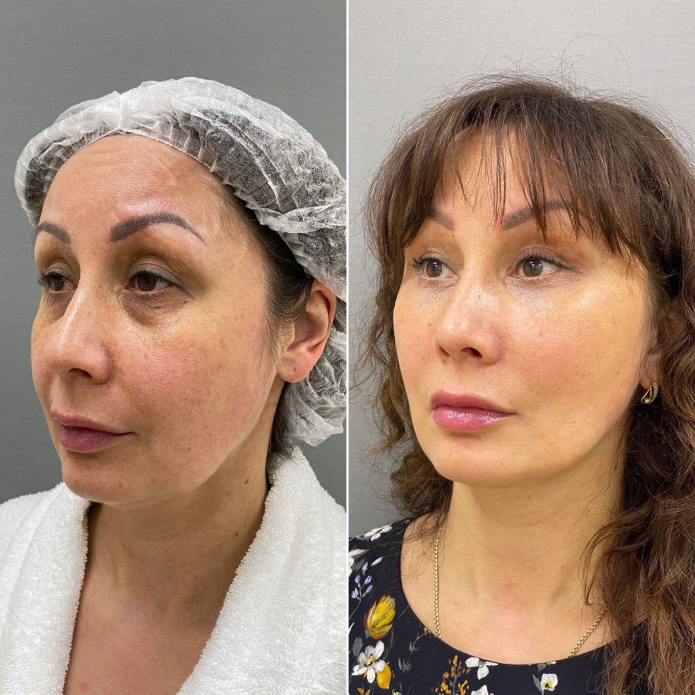 Пациентка пластического хирурга Марины Четвериковой до и после комплексного омоложения лица и верхней блефаропластики.