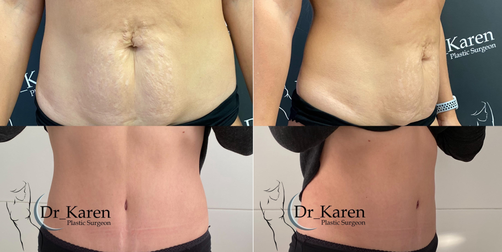 Пациентка пластического хирурга Карена Пайтяна. Фото до и после абдоминопластики с переносом пупка и с ушиванием диастаза. Также была выполнена липосакция живота и боков.
