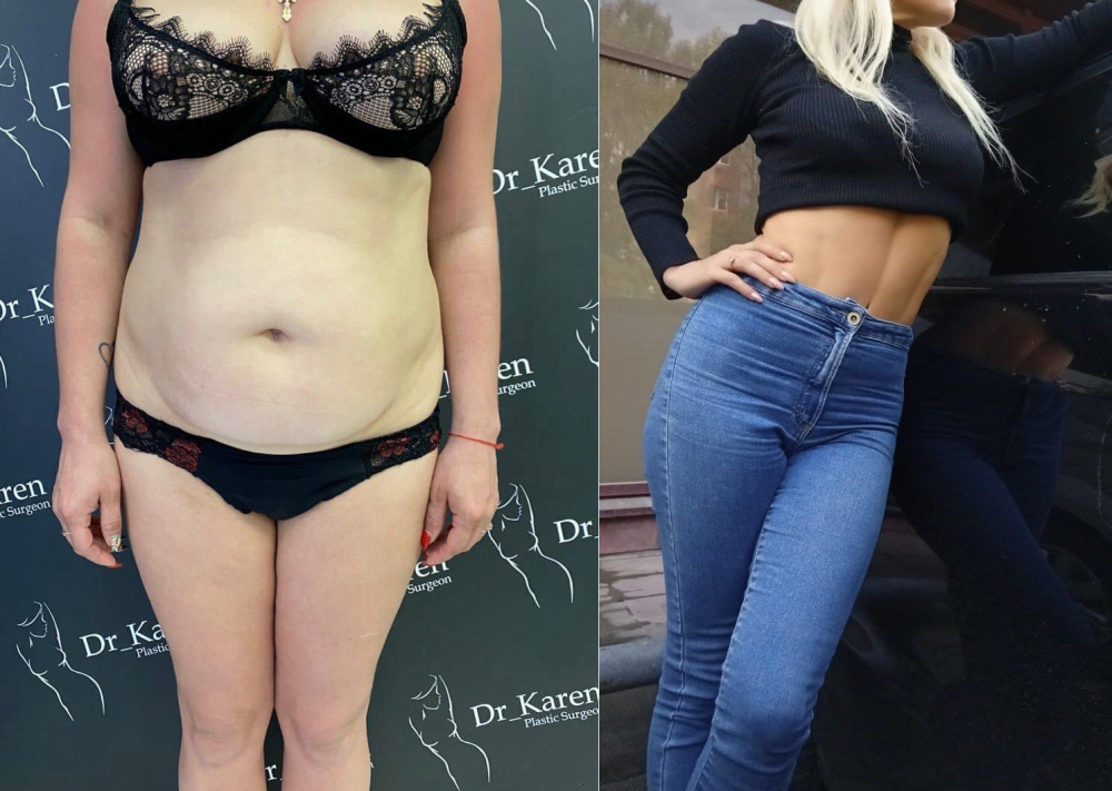 Пациентка доктора Карена после абдоминопластики с переносом пупка