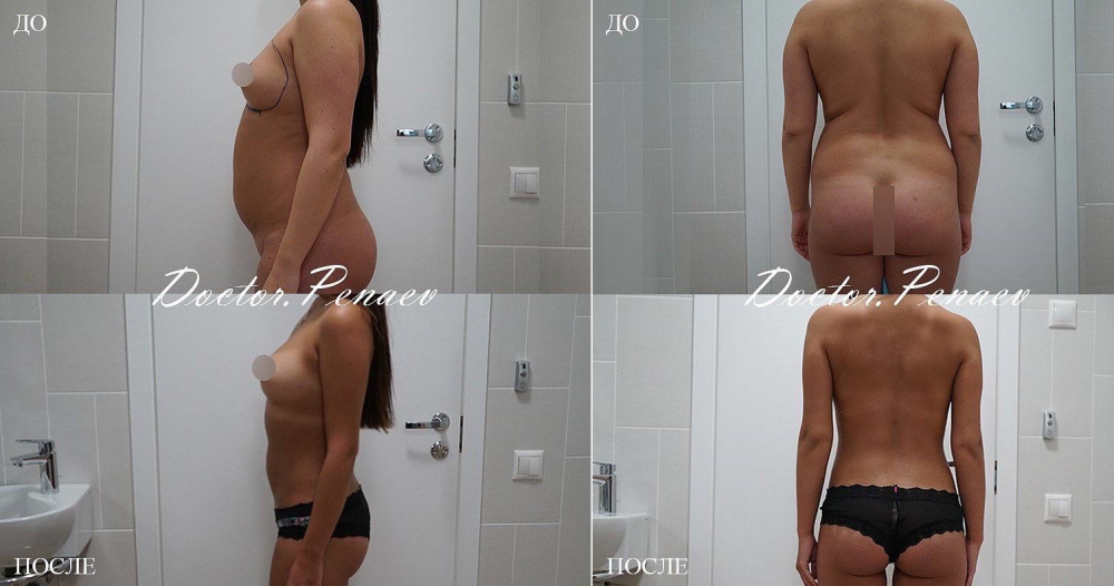 Пациентка (33 года) доктора Арслана Пенаева. Женщине выполнена фундаментальная липотрансформация с использованием VASER-технологии.
