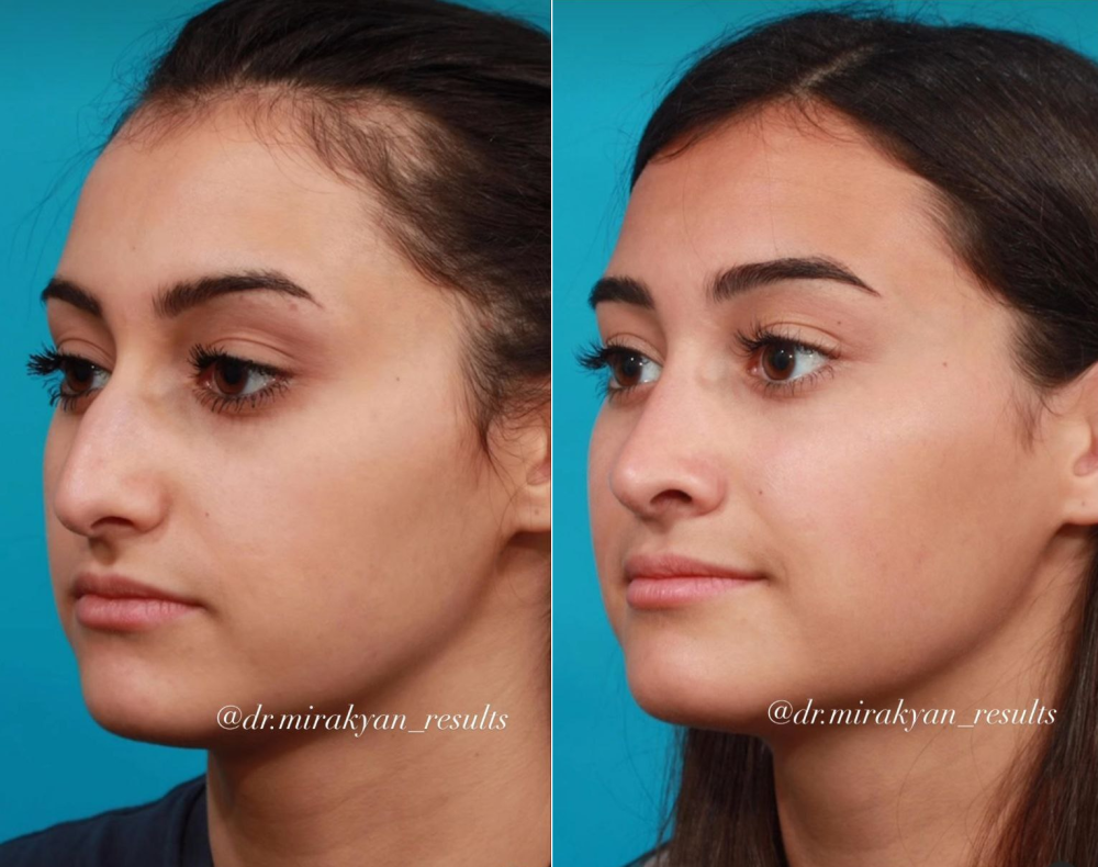 Фото пациентки пластического хирурга Гукаса Миракяна до и после ринопластики