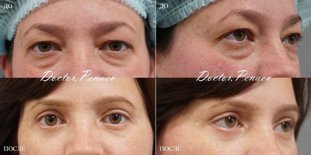 Пациентка доктора Пенаева до и после круговой блефаропластики
