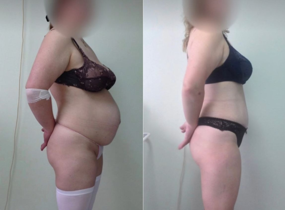 Пациентка пластического хирурга Светланы Пшонкиной до и после одновременной абдоминопластики и грыжесечения