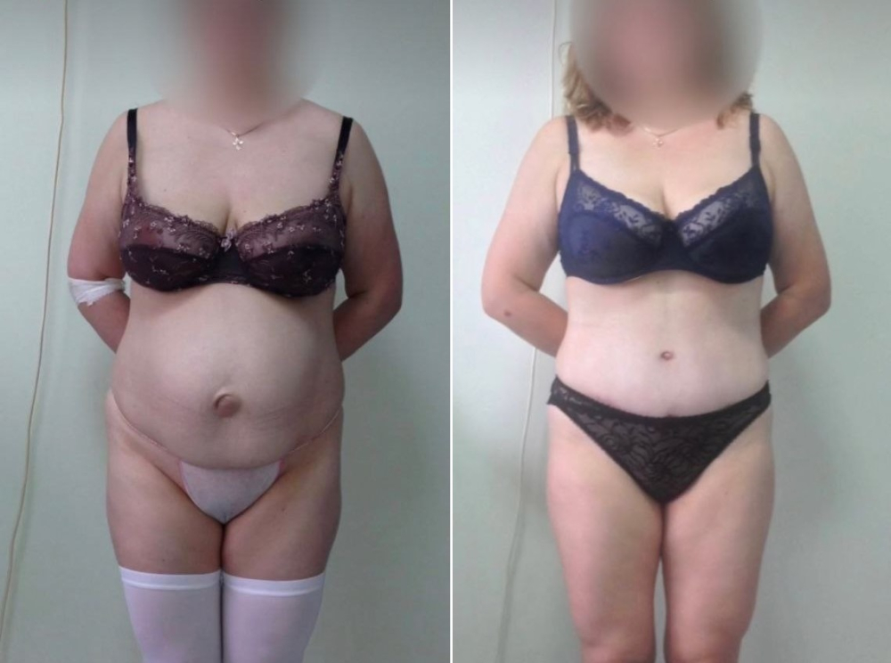 Пациентка пластического хирурга Светланы Пшонкиной до и после одновременной абдоминопластики и грыжесечения