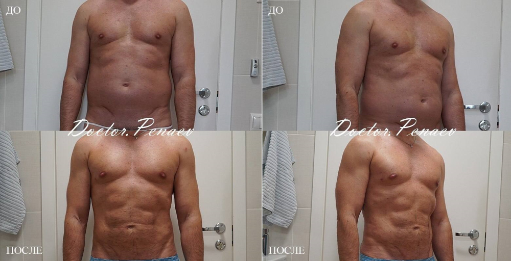 Пациент (43 года) доктора Арслана Пенаева. Выполнена VASER-липосакция передней брюшной стенки и пояснично-крестцовой области
