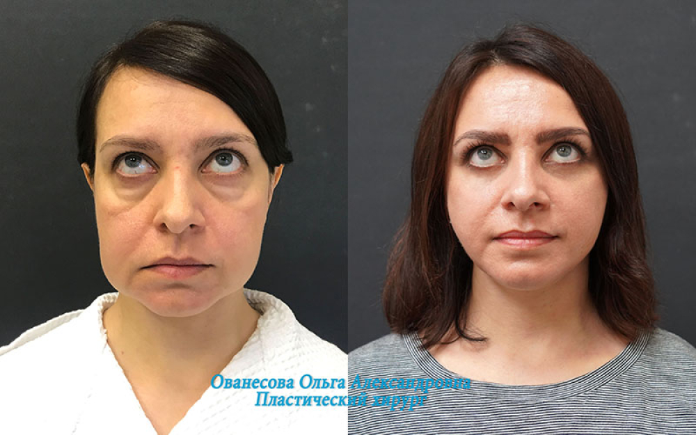 Пациентка пластического хирурга Ольги Ованесовой на фото до и после удаления малярных мешков и омоложения лица