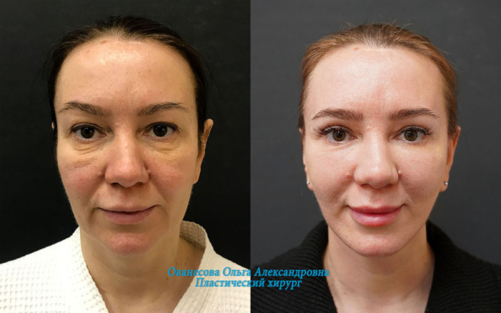 Пациентка пластического хирурга Ольги Ованесовой до и после удаления малярных мешков и омоложения лица и шеи.