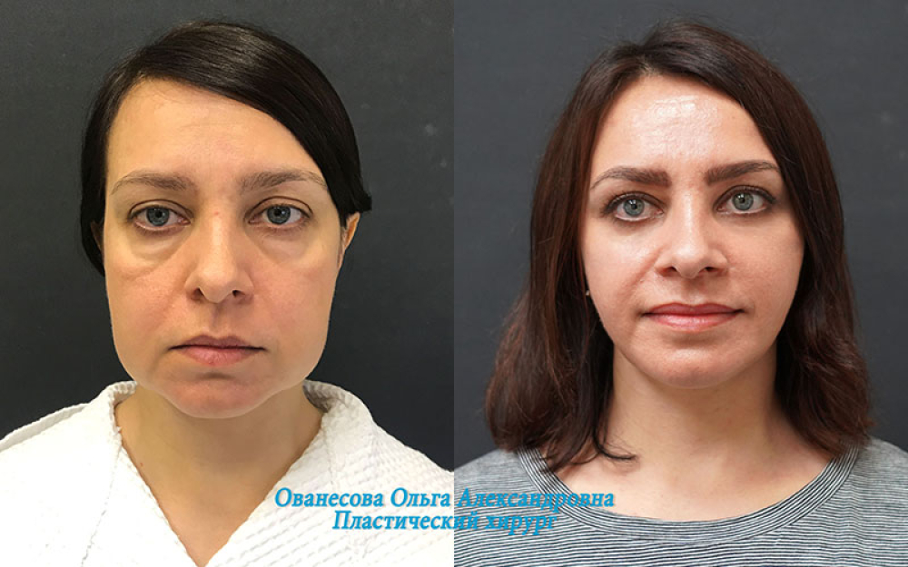 Пациентка пластического хирурга Ольги Ованесовой до и после удаления малярных мешков и омоложения лица