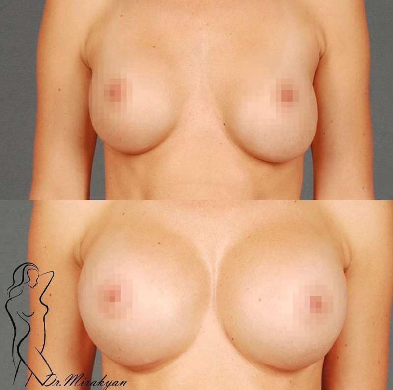 Пациентка пластического хирурга Гукаса Миракяна. Фото до и после повторной маммопластики.