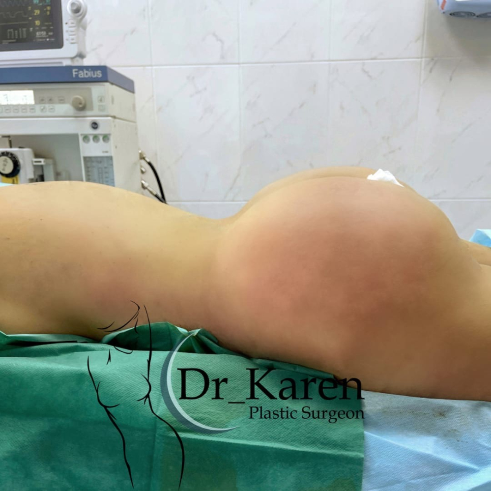 Пациентке выполнили липомоделирование тела с увеличением ягодиц.