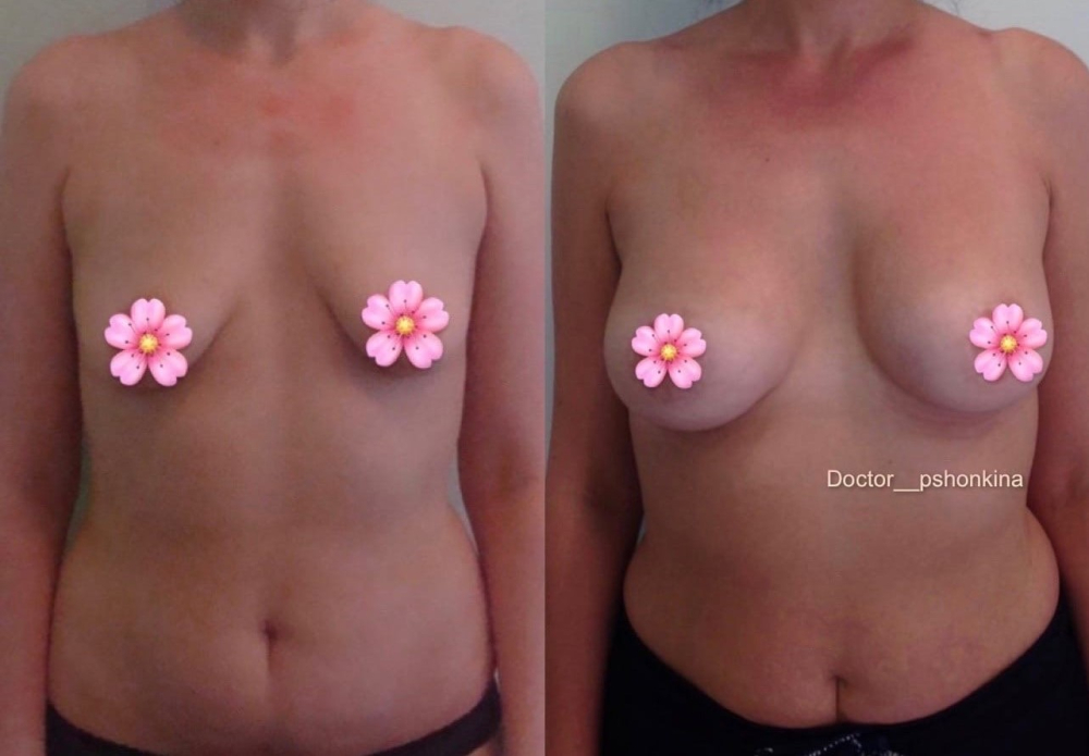 Пациентка пластического хирурга Светланы Пшонкиной. Фото до и после увеличения груди с подтяжкой.
