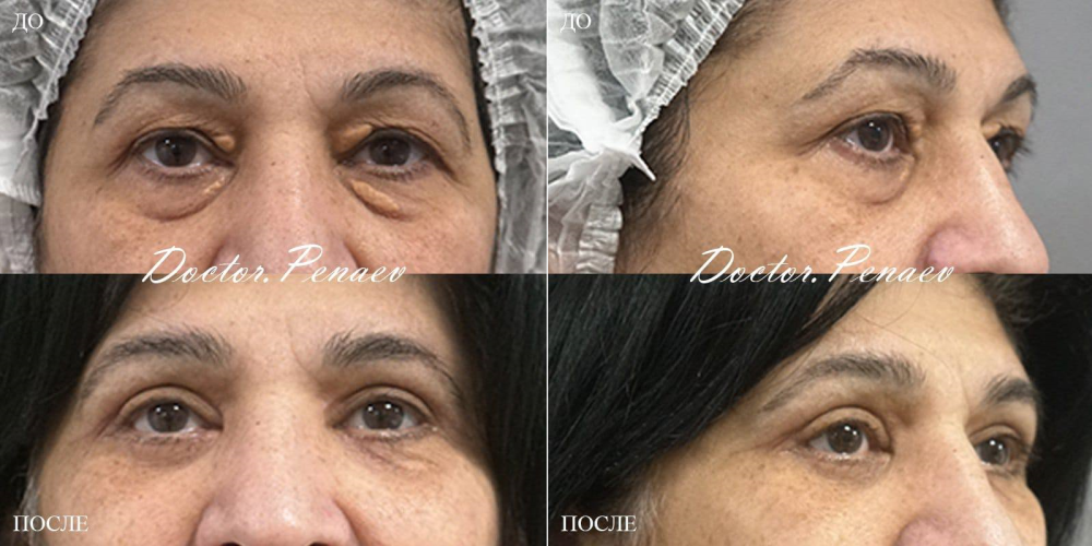 Пациентка профессора Пенаева до и после круговой блефаропластики и кантопексии, удаления ксантом