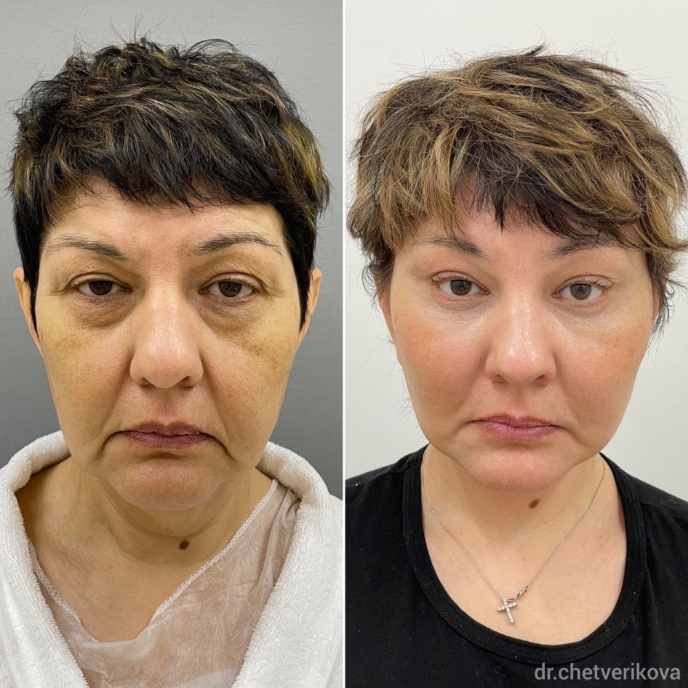 Пациентка пластического хирурга Марины Четвериковой до и после эндоскопического омоложения и СМАС-пластики лица