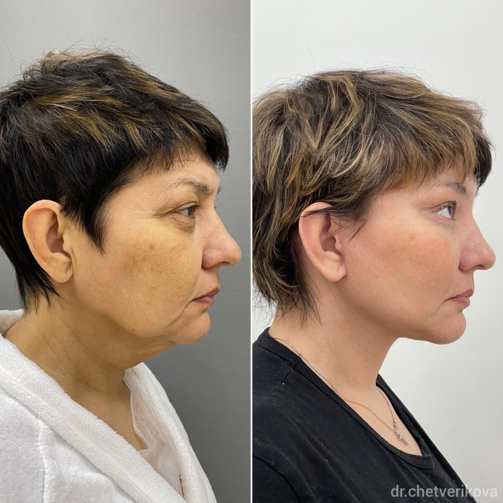 Пациентка пластического хирурга Марины Четвериковой до и после эндоскопического омоложения и СМАС-пластики лица.