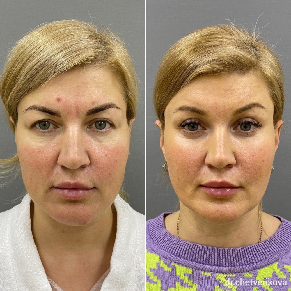 Пациентка пластического хирурга Марины Четвериковой до и после эндоскопического омоложения лица и блефаропластики