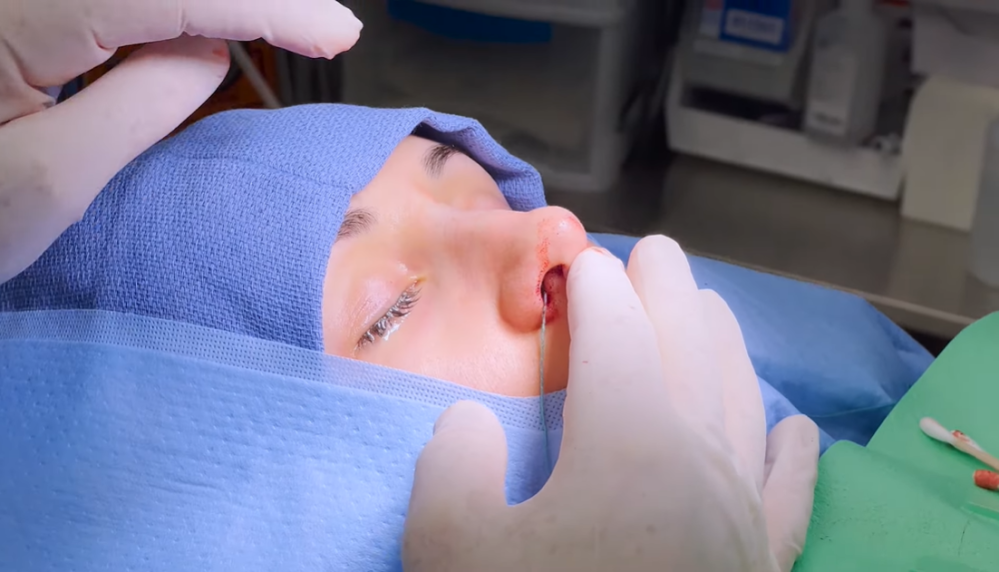 Что такое ринопластика