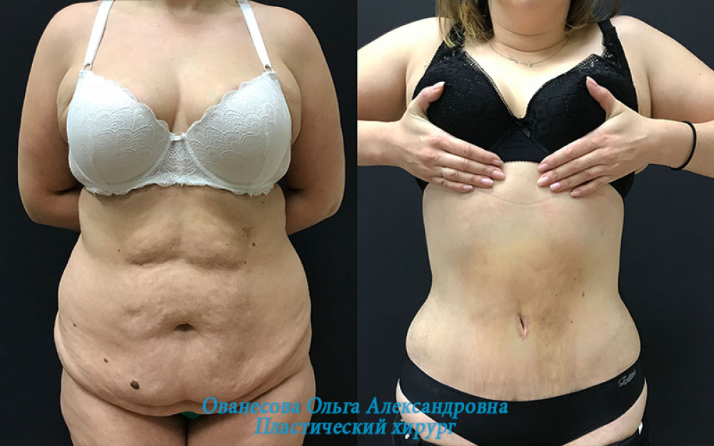 Пациентка (32 года) пластического хирурга Ольги Ованесовой до и после абдоминопластики после родов