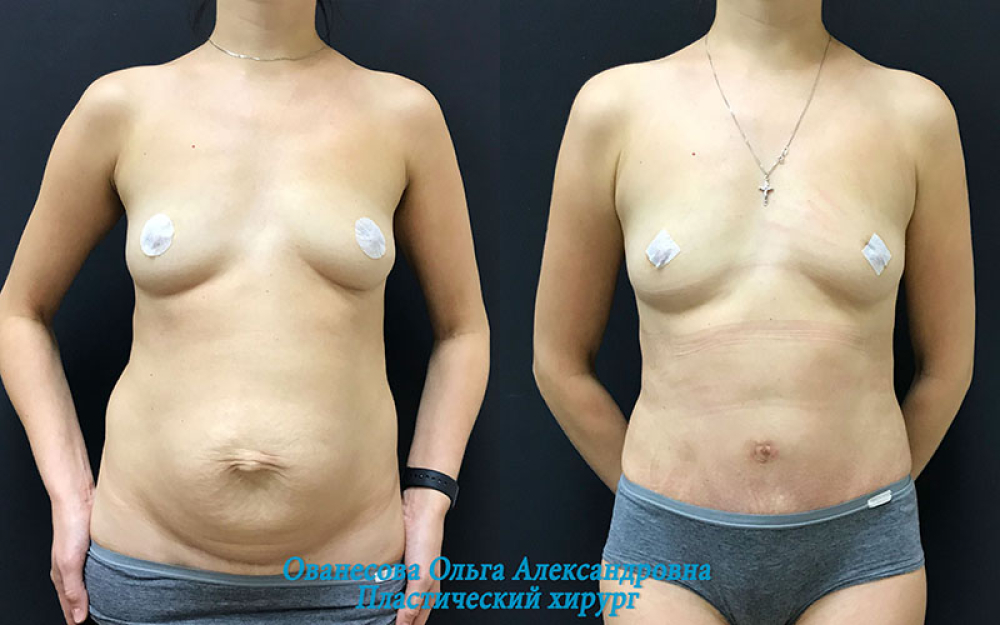 Пациентка (36 лет) пластического хирурга Ольги Ованесовой до и после операции по послеродовому восстановлению