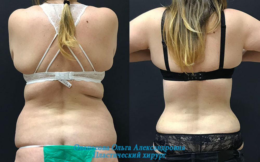 Пациентка пластического хирурга Ольги Ованесовой до и после абдоминопластики после родов