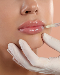 Увеличение губ препаратом Рестилайн