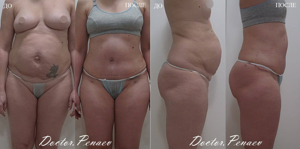 Пациентка доктора Пенаева до и после липоабдоминопластики